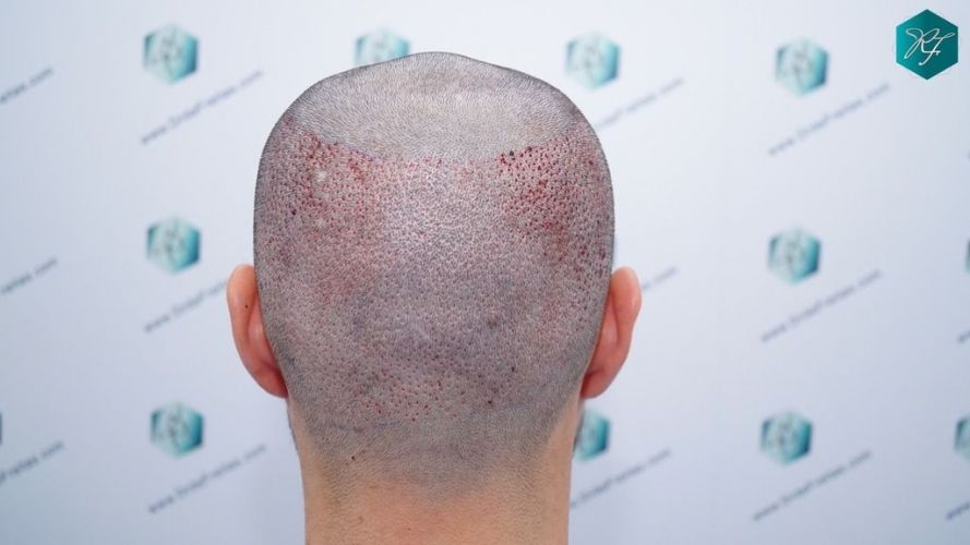 Injerto Capilar Técnica FUE 2046 Grafts (5983 Pelos) 27 trasplante de pelo