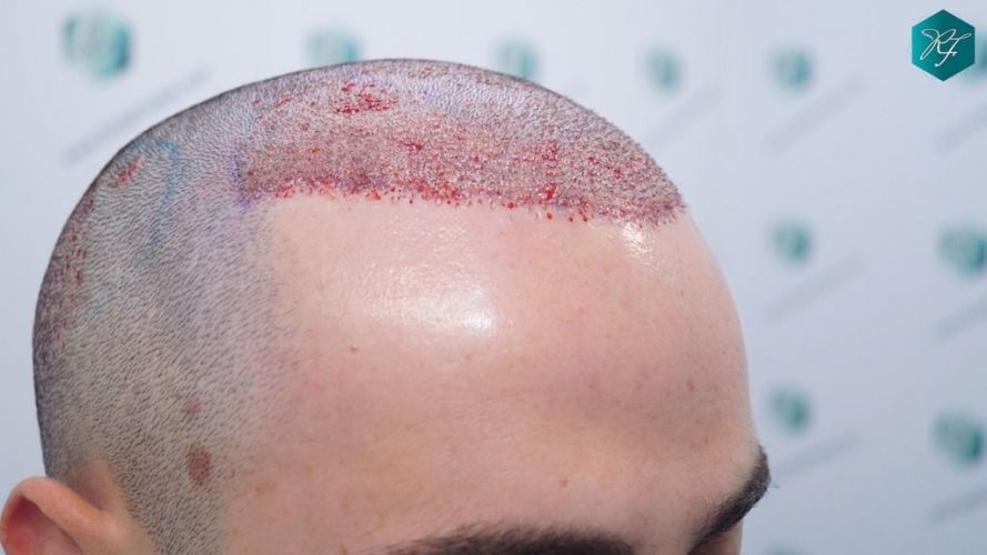 Injerto Capilar Técnica FUE 2046 Grafts (5983 Pelos) 20 trasplante de pelo