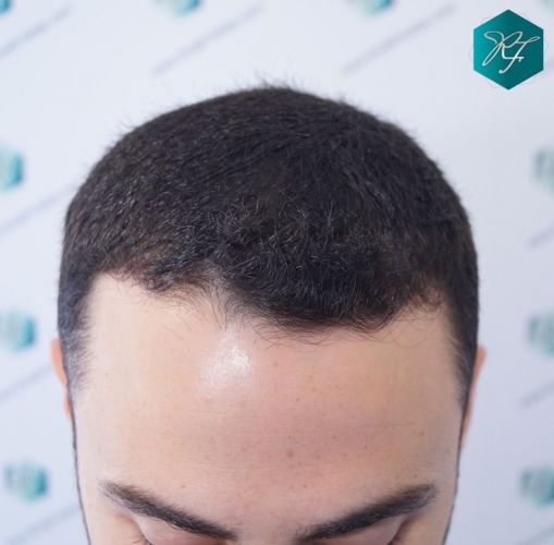 Injerto Capilar Técnica FUE 2046 Grafts (5983 Pelos) 3 evolución trasplante de pelo