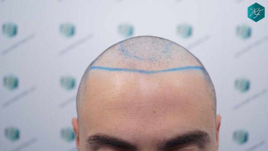 Injerto Capilar Técnica FUE 2046 Grafts (5983 Pelos) 14 diseño linea injerto capilar