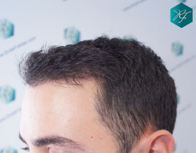 Injerto Capilar Técnica FUE 2046 Grafts (5983 Pelos) 7 tecnica fue en España