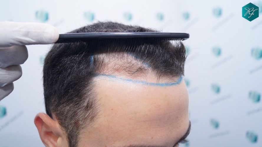 Injerto Capilar Técnica FUE 2046 Grafts (5983 Pelos) 10 clinica capilar valencia