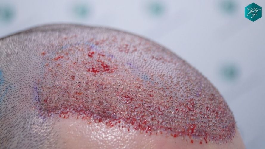 Injerto Capilar Técnica FUE 2046 Grafts (5983 Pelos) 21 tecnica fue en España