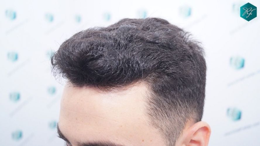 Injerto Capilar Técnica FUE 2046 Grafts (5983 Pelos) 34 resultados trasplante capilar