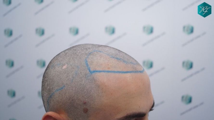 Injerto Capilar Técnica FUE 2046 Grafts (5983 Pelos) 16 resultados trasplante capilar