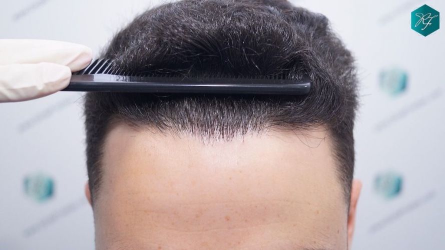Injerto Capilar Técnica FUE 2046 Grafts (5983 Pelos) 39 resultados trasplante capilar