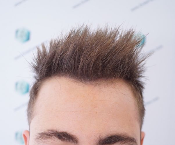 Injerto Capilar Técnica FUE 3003 Grafts (6479 pelos) 20 resultados obtenidos trasplante de pelo