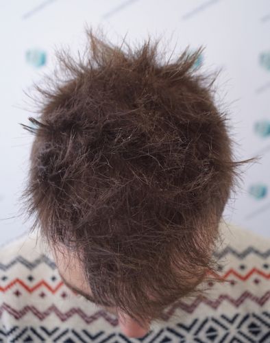 Injerto Capilar Técnica FUE 3003 Grafts (6479 pelos) 32 trasplante de pelo en España