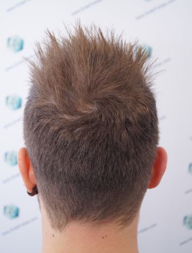 Injerto Capilar Técnica FUE 3003 Grafts (6479 pelos) 33 trasplante de pelo en España