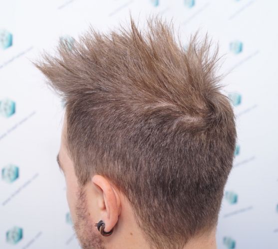 Injerto Capilar Técnica FUE 3003 Grafts (6479 pelos) 30 resultados injerto capilar