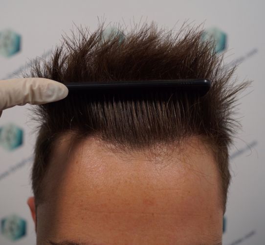 Injerto Capilar Técnica FUE 3003 Grafts (6479 pelos) 22 trasplante de pelo en España