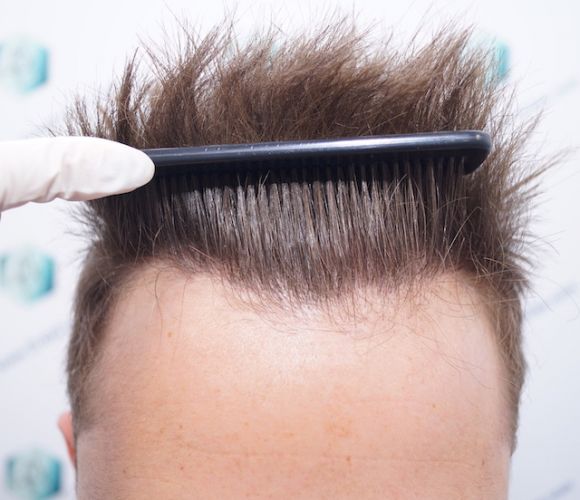 Injerto Capilar Técnica FUE 3003 Grafts (6479 pelos) 21 injerto capilar en valencia