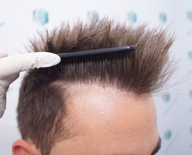Injerto Capilar Técnica FUE 3003 Grafts (6479 pelos) 26 trasplante de pelo en España