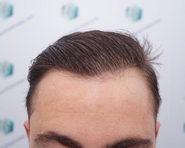 Injerto Capilar Técnica FUE 3003 Grafts (6479 pelos) 41 injerto capilar en valencia