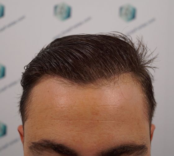 Injerto Capilar Técnica FUE 3003 Grafts (6479 pelos) 43 trasplante de pelo en España