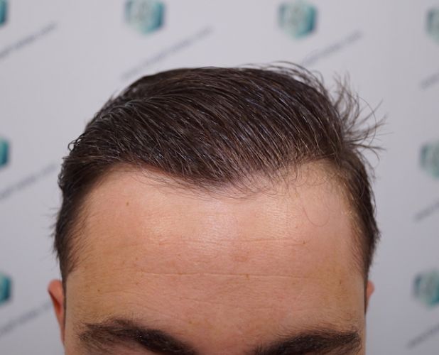 Injerto Capilar Técnica FUE 3003 Grafts (6479 pelos) 42 trasplante de pelo en valencia