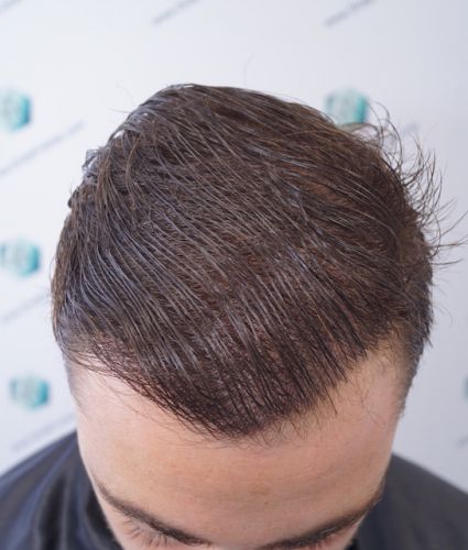Injerto Capilar Técnica FUE 3003 Grafts (6479 pelos) 44 trasplante de pelo en españa
