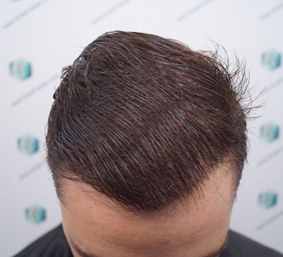 Injerto Capilar Técnica FUE 3003 Grafts (6479 pelos) 45 injerto capilar en valencia