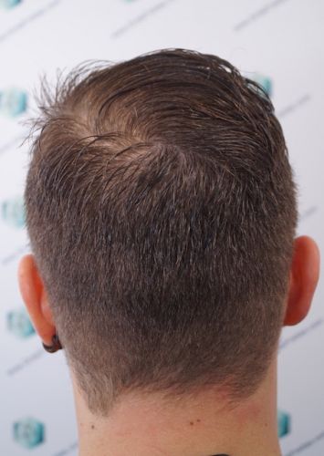 Injerto Capilar Técnica FUE 3003 Grafts (6479 pelos) 50 trasplante de pelo en España