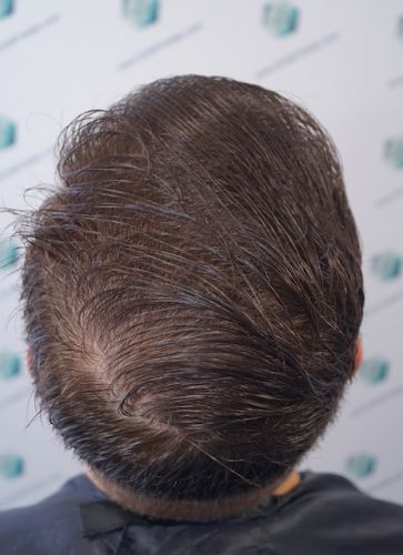 Injerto Capilar Técnica FUE 3003 Grafts (6479 pelos) 49 trasplante de pelo en España