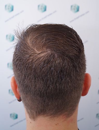 Injerto Capilar Técnica FUE 3003 Grafts (6479 pelos) 51 trasplante de pelo en España