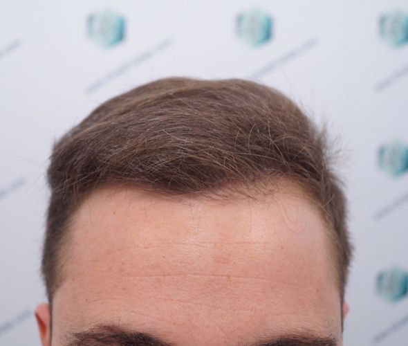 RESULTADOS INJERTO CAPILAR 12 MESES resultados obtenidos trasplante de pelo