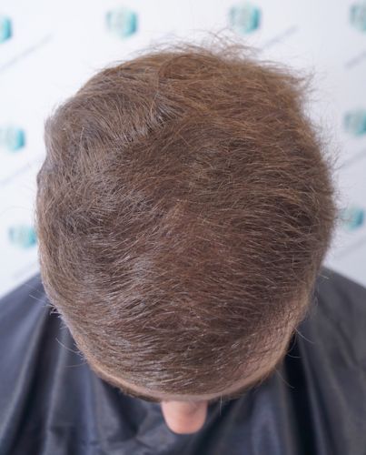 Injerto Capilar Técnica FUE 3003 Grafts (6479 pelos) 16 trasplante de pelo en españa