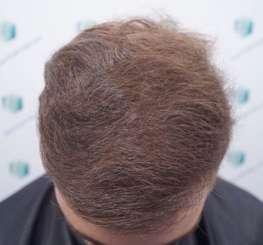 Injerto Capilar Técnica FUE 3003 Grafts (6479 pelos) 17 trasplante de pelo en españa