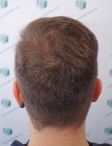 Injerto Capilar Técnica FUE 3003 Grafts (6479 pelos) 34 trasplante de pelo en España