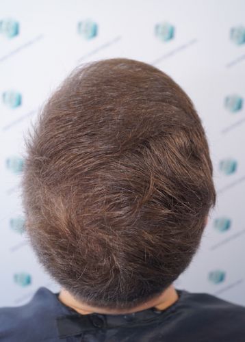 Injerto Capilar Técnica FUE 3003 Grafts (6479 pelos) 36 trasplante de pelo en valencia