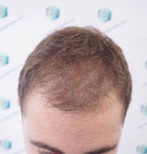 Injerto Capilar Técnica FUE 3003 Grafts (6479 pelos) 15 antes del trasplante capilar
