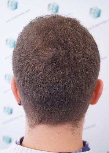 Injerto Capilar Técnica FUE 3003 Grafts (6479 pelos) 35 trasplante de pelo en valencia