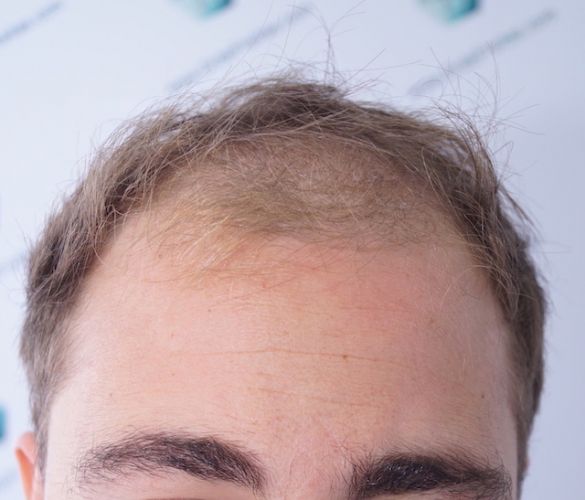 Injerto Capilar Técnica FUE 3003 Grafts (6479 pelos) 1 trasplante de pelo en España