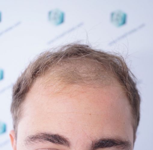 ANTES TRASPLANTE CAPILAR trasplante de pelo en valencia