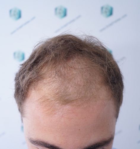 Injerto Capilar Técnica FUE 3003 Grafts (6479 pelos) 2 trasplante de pelo en España
