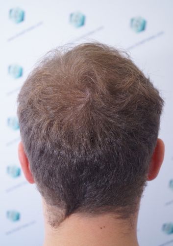 Injerto Capilar Técnica FUE 3003 Grafts (6479 pelos) 31 después del trasplante capilar