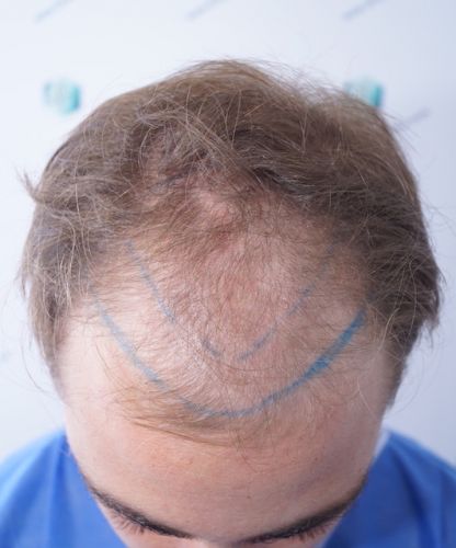 Injerto Capilar Técnica FUE 3003 Grafts (6479 pelos) 6 antes del trasplante capilar