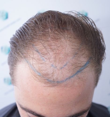 Injerto Capilar Técnica FUE 3003 Grafts (6479 pelos) 8 antes de trasplante de pelo