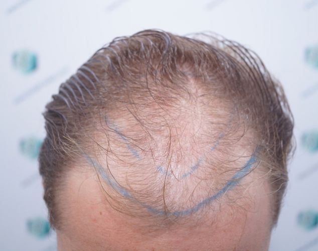 Injerto Capilar Técnica FUE 3003 Grafts (6479 pelos) 5 línea injerto capilar