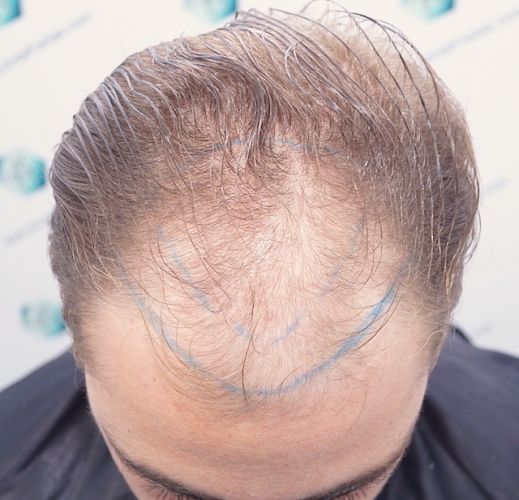 Injerto Capilar Técnica FUE 3003 Grafts (6479 pelos) 7 injerto capilar en valencia