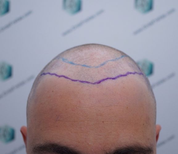 Injerto Capilar Técnica FUE 3003 Grafts (6479 pelos) 10 DISEÑO LÍNEA INJERTO CAPILAR