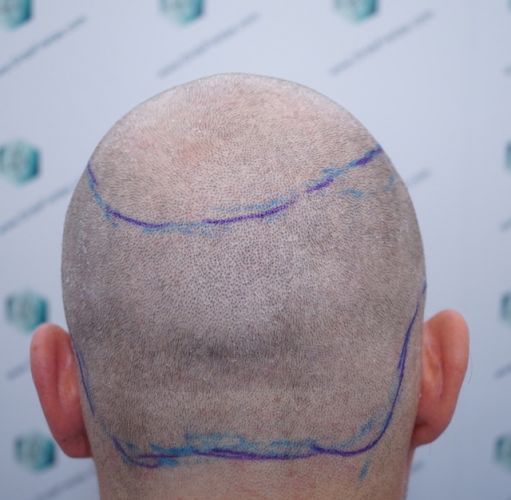 Injerto Capilar Técnica FUE 3003 Grafts (6479 pelos) 9 antes de trasplante de pelo