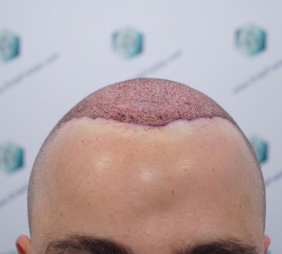 TRASPLANTE INJERTO CAPILAR trasplante capilar con técnica FUE