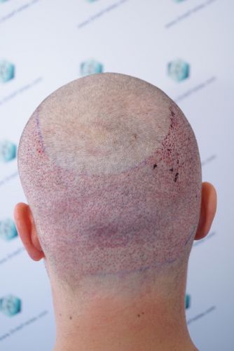 Injerto Capilar Técnica FUE 3003 Grafts (6479 pelos) 14 injerto capilar tecnica FUE