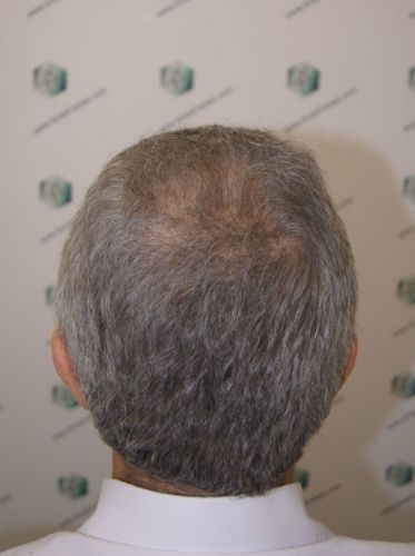 Injerto Capilar Técnica FUE 2911 Grafts (Pelos 6191) 15 RESULTADOS INJERTO CAPILAR EN 1 AÑO