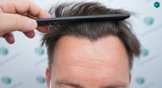Injerto Capilar Técnica FUE 2759 Grafts (6049 Pelos) 20 RESULTADOS INJERTO CAPILAR EN 12 MESES