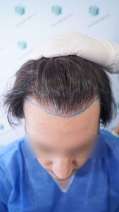 Injerto Capilar Técnica FUE 1916 Grafts (4597 Pelos) 9 DISEÑO LÍNEA INJERTO CAPILAR