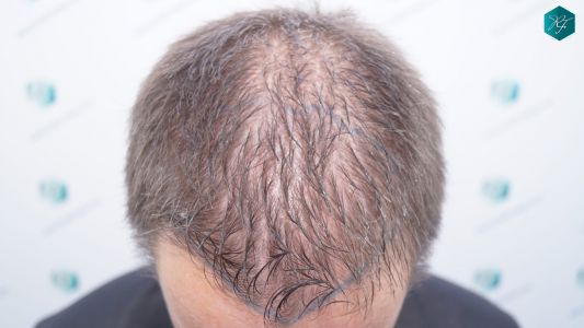 Injerto Capilar Técnica FUE 2759 Grafts (6049 Pelos) 7 Injerto Capilar Técnica FUE 2759 Grafts (6049 Pelos)