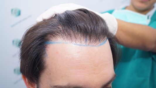 Injerto Capilar Técnica FUE 1916 Grafts (4597 Pelos) 11 DISEÑO LÍNEA INJERTO CAPILAR