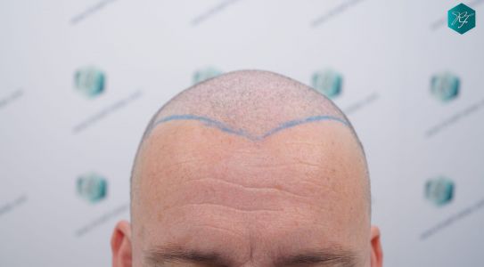 Injerto Capilar Técnica FUE 2759 Grafts (6049 Pelos) 8 DISEÑO LÍNEA INJERTO CAPILAR